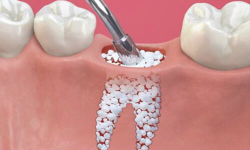 Illustration of a bone graft procedure done by the Costa Rica Dental Center in San Jose, Costa Rica.