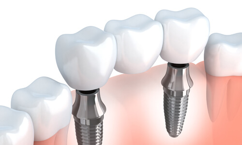 Illustration of an implant-supported bridge procedure done by the Costa Rica Dental Centre in San Jose, Costa Rica.  The picture shows an implant-supported bridge being placed in the lower jaw.