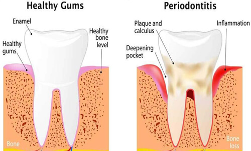 Illustration of a dental periodontal procedure done by the Costa Rica Dental Center in San Jose, Costa Rica.  The picture shows how a periodontal procedure is done in the lower jaw.