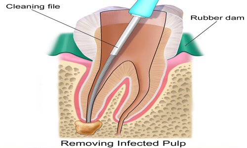 Illustration of a root canal procedure done by the Costa Rica Dental Center in San Jose, Costa Rica.  The picture shows how a root canal is performed in the lower jaw.